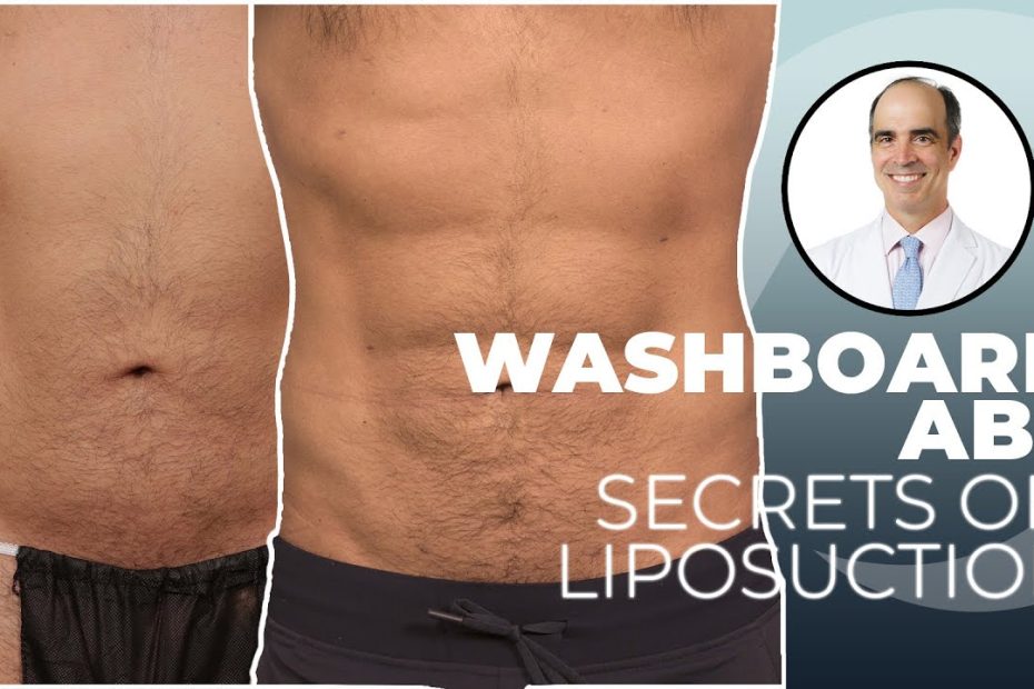 Liposuction for Guys: How to get rid of love handles and get a six-pack